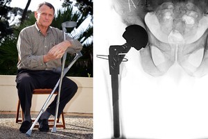 Bruce Greenfield had his hip joint replaced with the ASR system in 2009, pictured right, but this month had to replace this joint with another. Photo / Sarah Ivey