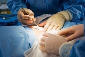 A Waikato surgeon cut out tissue he thought was a woman's gall-bladder before realising he had removed it 13 years earlier.
Photo / Thinkstock