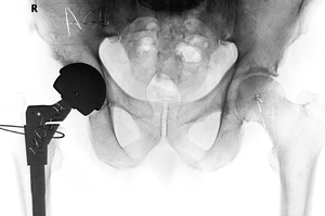 Hundreds of Kiwi patients have had surgery to replace the failed coblat and chrome metal hip. Photo / supplied