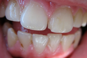 Damage caused to tooth enamel is irreversible.
Photo / Thinkstock