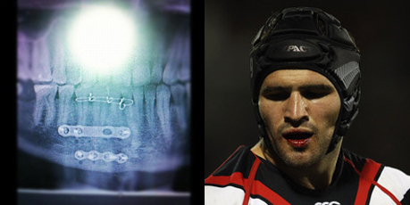 Nathan Friend played with a broken jaw, x-ray, left. Photo / Getty Images - Twitpic Nathan Friend played with a broken jaw, x-ray, left. Photo / Getty Images - Twitpic
