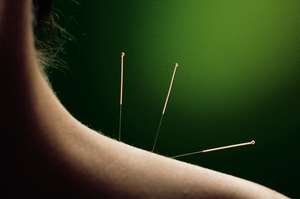 Acupuncture is incredibly recognised as a legitimate form of healthcare. Photo / Thinkstock