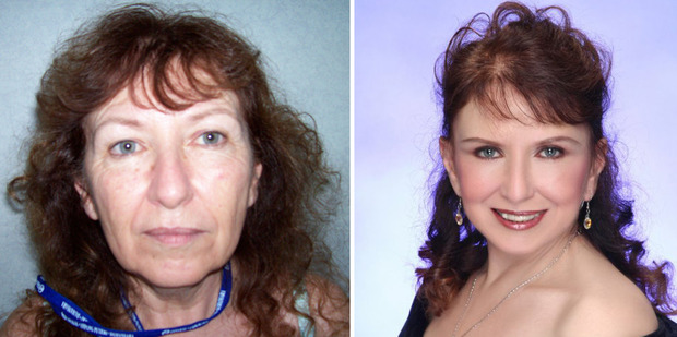 Christine Fiori before and after her cosmetic surgery. Photo / Supplied