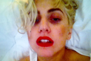 Lady Gaga shows off her bruises in a Twitter photo. Photo / Twitter