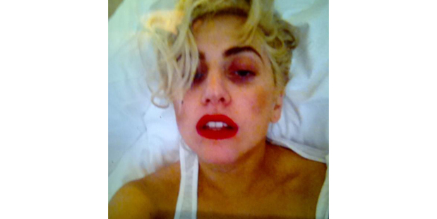 Pop singer Lady Gaga posted images on Twitter of the bruises she sustained during a New Zealand concert. Photo / Supplied