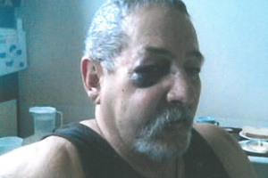 Peter James Stone after the attack. Photo / Hawkes Bay Today