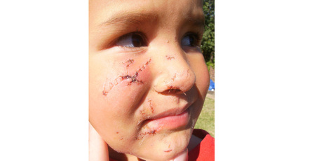 Tane Saneva, now 4, needed surgery to repair facial injuries after he was attacked by a dog at his father's property last year. Photo / Supplied