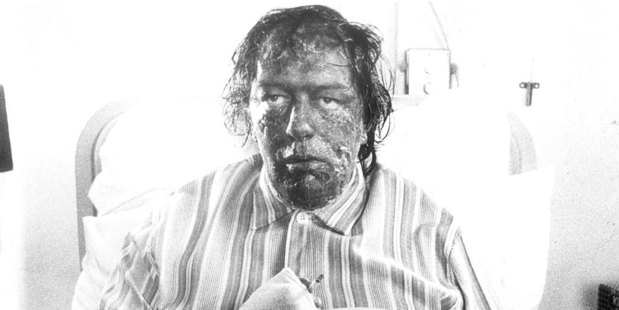Michael Gambon in The Singing Detective. Photo / Supplied