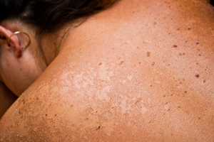 Chanxing Du had surgery for his melanoma but died in 2007. Photo / Thinkstock