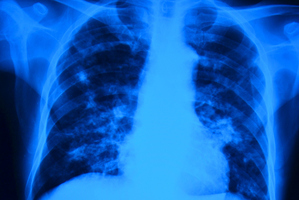 TB is second only to HIV/AIDS as the greatest infectious killer worldwide. Photo / Thinkstock