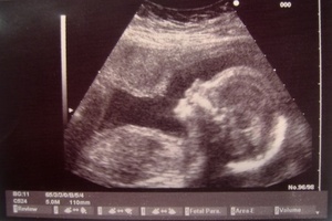 With the uterine transplant from their mothers, two Swedish women have the chance to conceive. Photo / Thinkstock