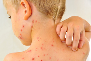 Almost every child in Mt Eden has been immunised against chicken pox, says Dita de Boni.Photo / Thinkstock