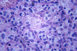 Pancreatic cancer is the fourth most fatal caner.Photo / Thinkstock