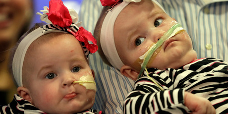 Allison, (left) and Amelia, the nine-month-old girls who were formerly conjoined twins make their debut at a hospital in Philadelphia. Photo / AP