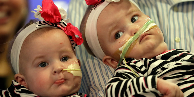 Allison, (left) and Amelia, the nine-month-old girls who were formerly conjoined twins make their debut at a hospital in Philadelphia. Photo / AP