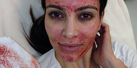 Kim Kardashian after undergoing a 'vampire facial'.