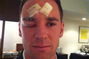 All Whites striker Shane Smeltz will visit the plastic surgeon for the second time this year after splitting his forehead open in Friday night's World Cup qualifier in Dunedin. Photo / Twitter.