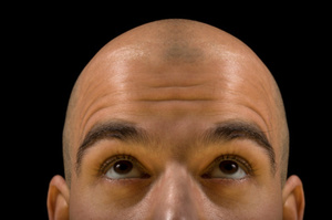 Baldness could be the first sign of heart disease.Photo / Thinkstock