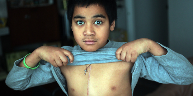 Tristan Katoa has a 15cm scar from surgery after being rushed to Starship Children's Hospital with rheumatic fever. Photo / Doug Sherring