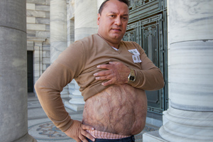 Former soldier Damien Nepata, displaying the burn injuries he received in a petrol explosion while serving in the NZ Army. Photo / Mark Mitchell