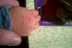 Starship hospital is treating up to three cases a day of human hand, foot and mouth disease. Photo / Supplied