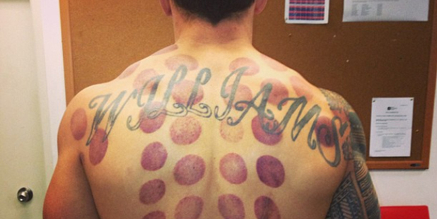 Sonny Bill Williams has been trying out a treatment that's popular with celebrities.
