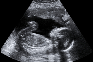 Doctors say the girl's life and that of the fetus are at high risk. File photo / Getty Images