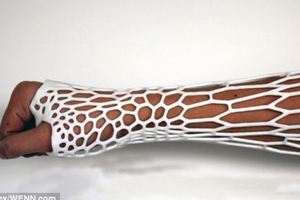 Computer software determines the optimum bespoke shape for the exoskeleton, with denser support focused around the fracture itself.