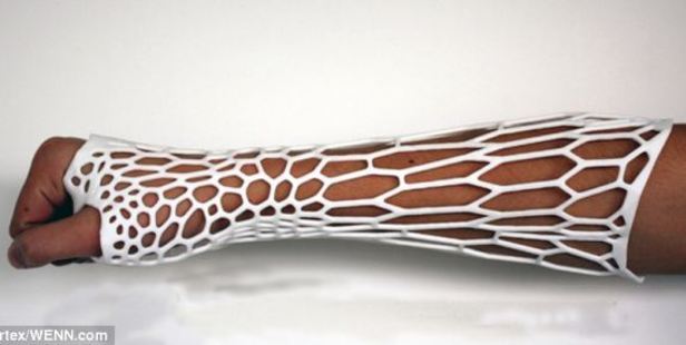 Computer software determines the optimum bespoke shape for the exoskeleton, with denser support focused around the fracture itself.