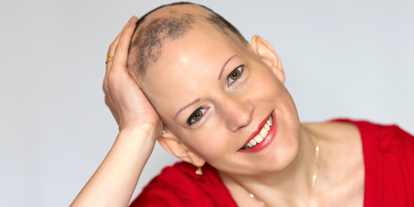 Joanna Parsons shares her battle with alopecia. Photo / Martin Hunter
