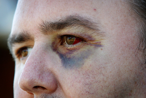 Glenn Cooper (pictured) showing the bruises on his face after an assault by Kurtis Haiu. Photo / Sarah Ivey