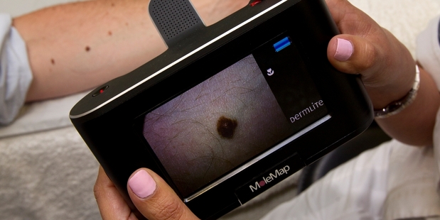 MoleMap is one of 11 companies still in the contest. Photo / Dean Purcell