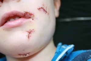 Ben Oliver with the wounds he received during the dog attack.