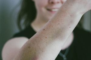 Erin Walker suffered bruising during the encounter. Photo / Erin Walker