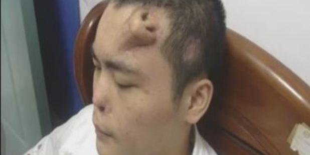 Xiaolian, 22, had a new nose grown on his forehead after his original one was irreparably damaged in a traffic accident. The new nose was sculpted from cartilage taken from his ribs.Photo / YouTube