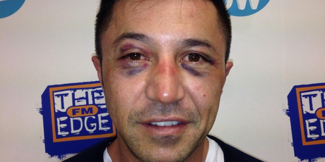 Mike Puru sports two black eyes after boxing training with Kevin Barry.
