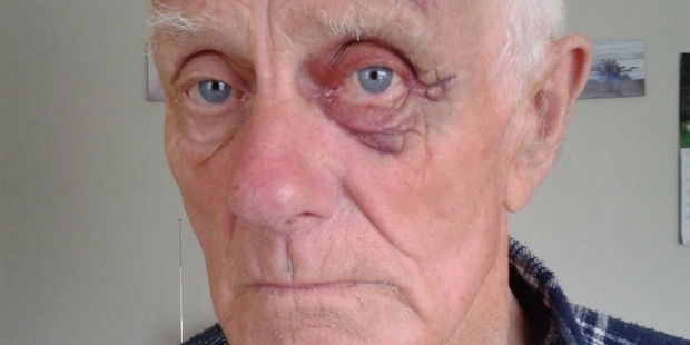 Dannevirke's Patrick Mullholland suffered a gashed head and a black eye after an attack by a dog in Rawhiti St last Thursday. Photo / Supplied
