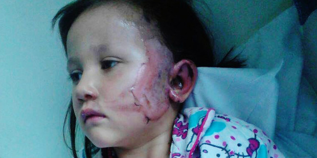 Elledy Harawira, who was burnt by a firework on Saturday night
