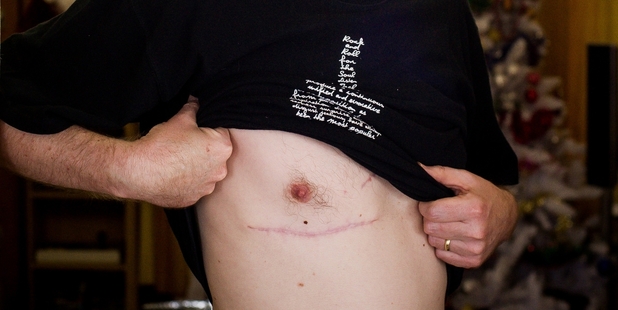Daniel Grobler, who has had multiple surgeries for melanoma. Photo / Jason Dorday