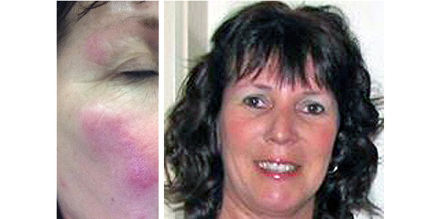 Debbie Roome had an allergic reaction after being bitten by bed bugs at an airport motel.