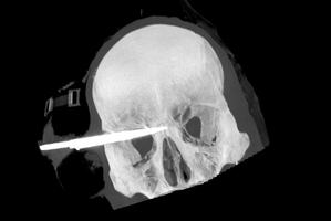 The young man who was stabbed in the head with a 90mm blade is in a stable condition after surgery.