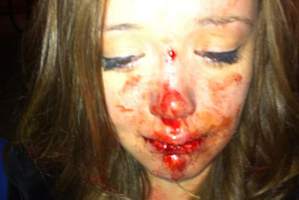 Ella Ekatone says a police officer pushed her to the ground with such force her teeth were ripped out at the roots. Photo / Supplied
