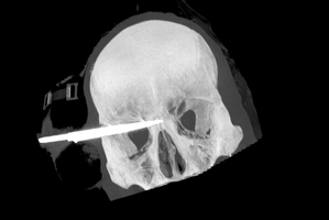The young man who was stabbed in the head with a 90mm blade is in a stable condition after surgery.