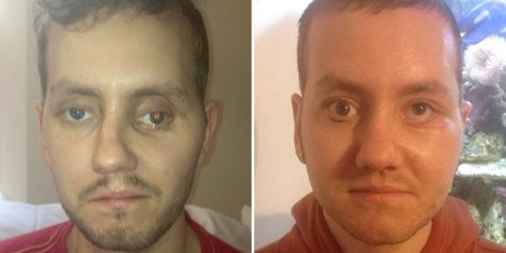 Stephen Power before and after having facial reconstruction surgery.
Photo / ABMU Health Board, AFP
