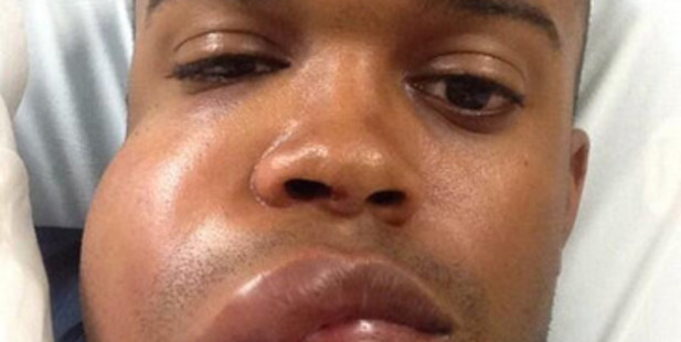 Delino DeShields Jr after wearing a 145 kmph fastball to the face. Photo / Twitter