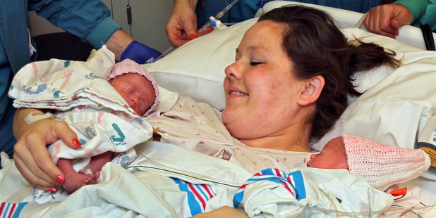Sarah Thistlethwaite holds her twin daughters, Jenna and Jillian, after her delivery of the monoamniotic twin girls. Photo / AP