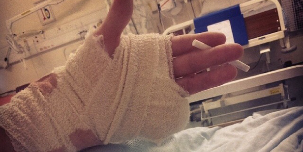 An Instagram photo shows the damage a raver did to his hand. Photo/Instagram