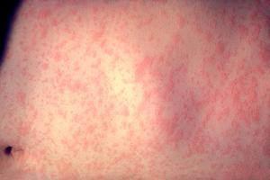 The skin of a patient after 3 days of measles infection.