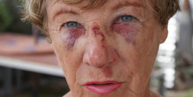 Lili Stanley, of Mosgiel, sustained injuries when she tripped in the undulating Dowling St car park on New Year's Eve