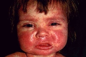 The serious effects of measles on a child. Photo / Supplied
